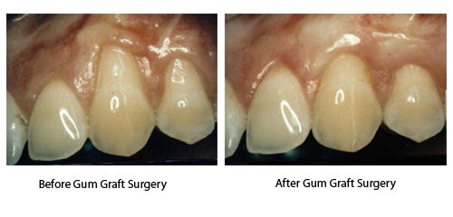 glenview-gum-graft-before-after